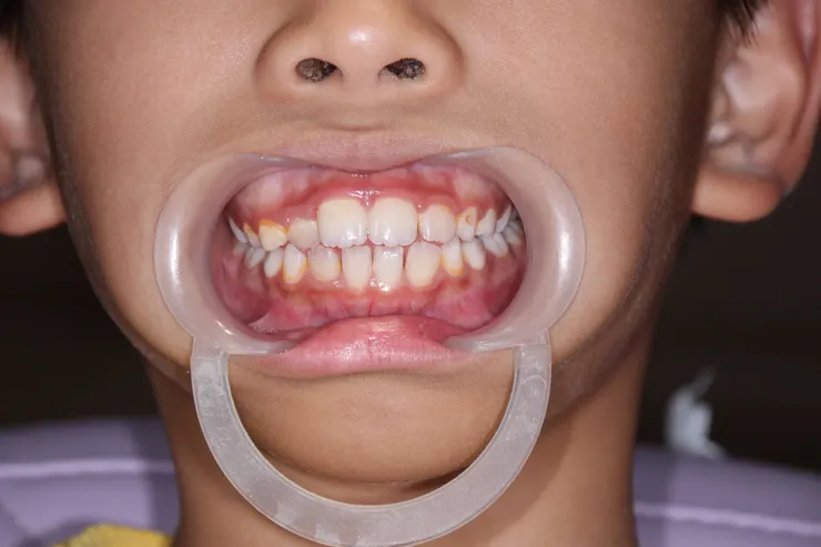 現在我診所用的是這種張口器，比較舒適，且無須幫忙，但有時我仍可透過讓小朋友幫忙置入口內，增加互動性