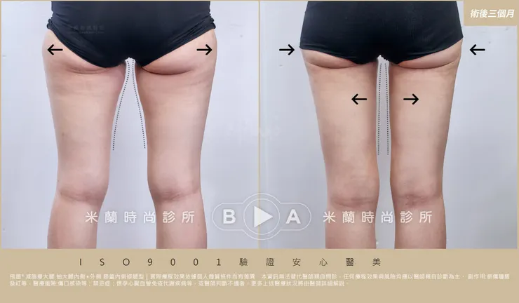 抽脂術後三個月比較圖