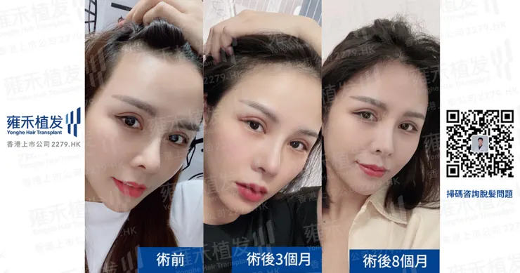 植髮效果