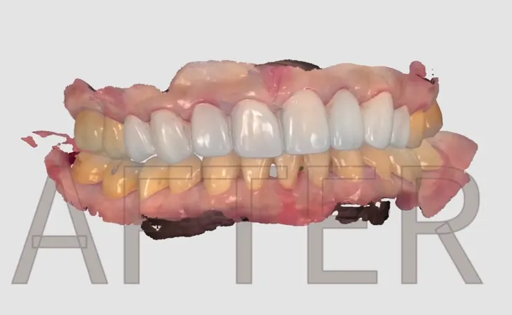 牙齒貼片(美白貼片)案例分享！從泛黃到亮白，重拾自信笑容的美齒蛻變！