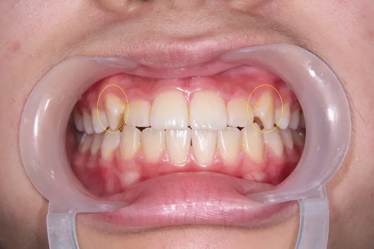 （姐姐）旋轉的虎牙，姐姐的，是分散到上面兩側，反而有對稱美，不一定需矯正牙齒