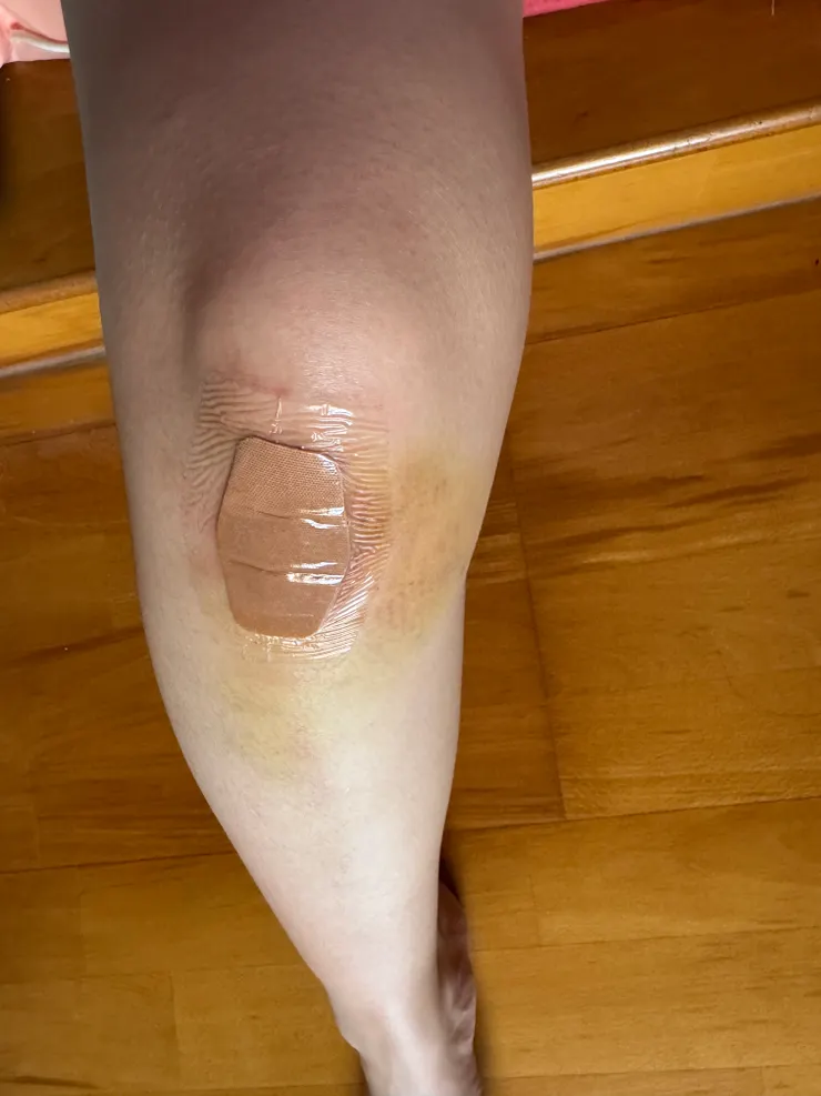 登愣～！給大家看看我包紮後的英勇模樣