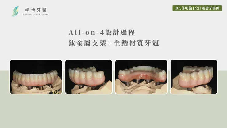 All-on-4設計過程：鈦金屬支架＋全鋯材質牙冠