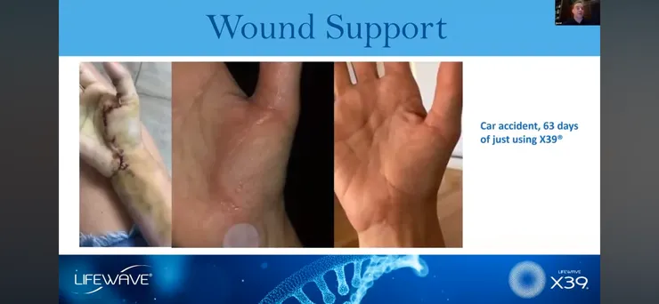 嚴重車禍斷手接回 單獨使用X39 63天後