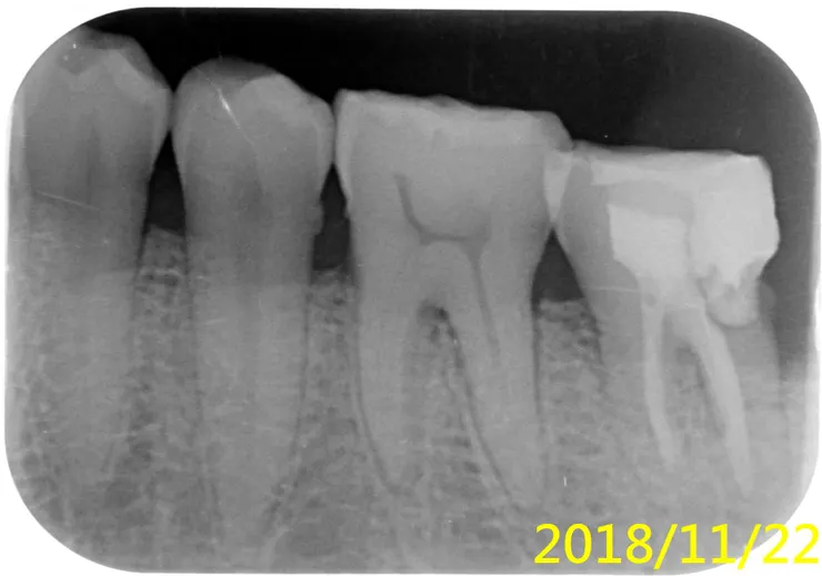 #38智齒拔完後,惡夢還沒結束,還要面對#37的根管治療(抽神經)
