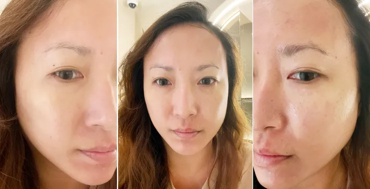 台北東區打雷射｜RedTouch PRO凍態雷射(果凍光)│台北打雷射推薦綻妍醫美診所