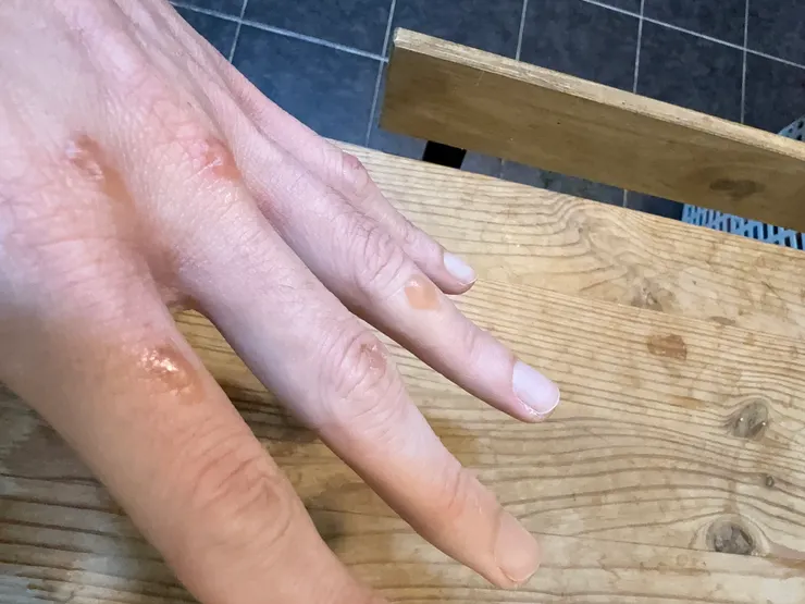 投錯醫後的大水泡