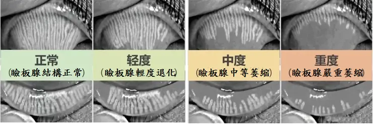 瞼板腺功能障礙程度說明