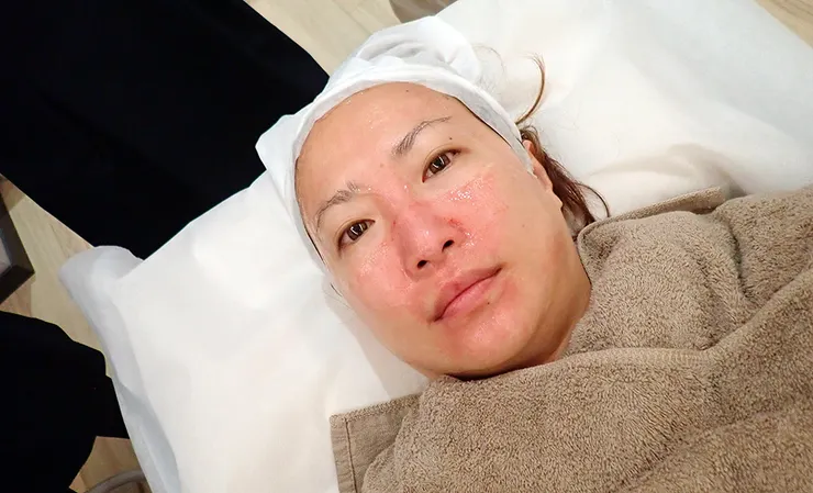 台北打皮秒│探索皮秒+蜂巢(超級鏡片ReFIX)-台北醫美診所推薦