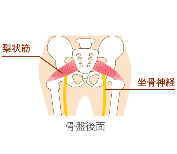 梨狀肌症候群 假性坐骨神經痛 臀部疼痛  腿麻腳麻 髖關節疼痛