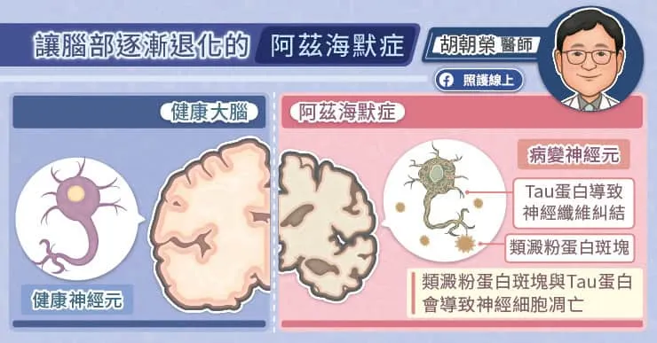 腦部逐漸退化的阿茲海默症