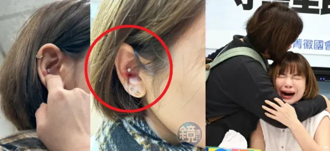 陳沂傷勢 / 出自鏡週刊