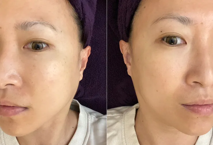 板橋美容去角質保養推薦│芮薇荷夢幻森林spa-板橋館│水飛梭氫水儀