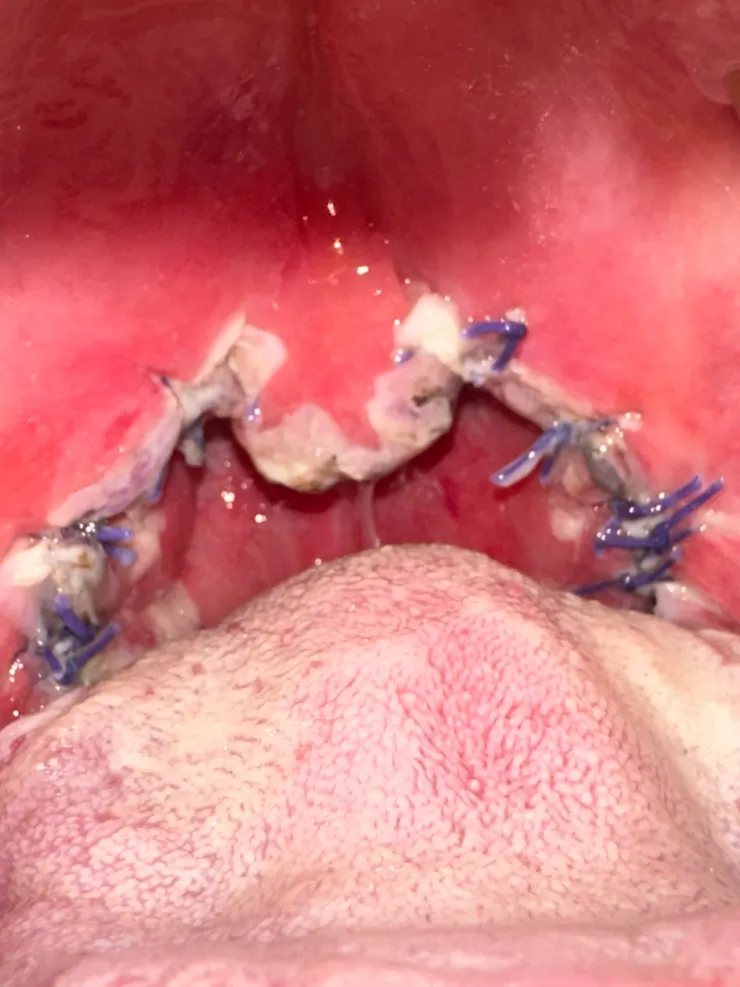 整個喉嚨都是縫線