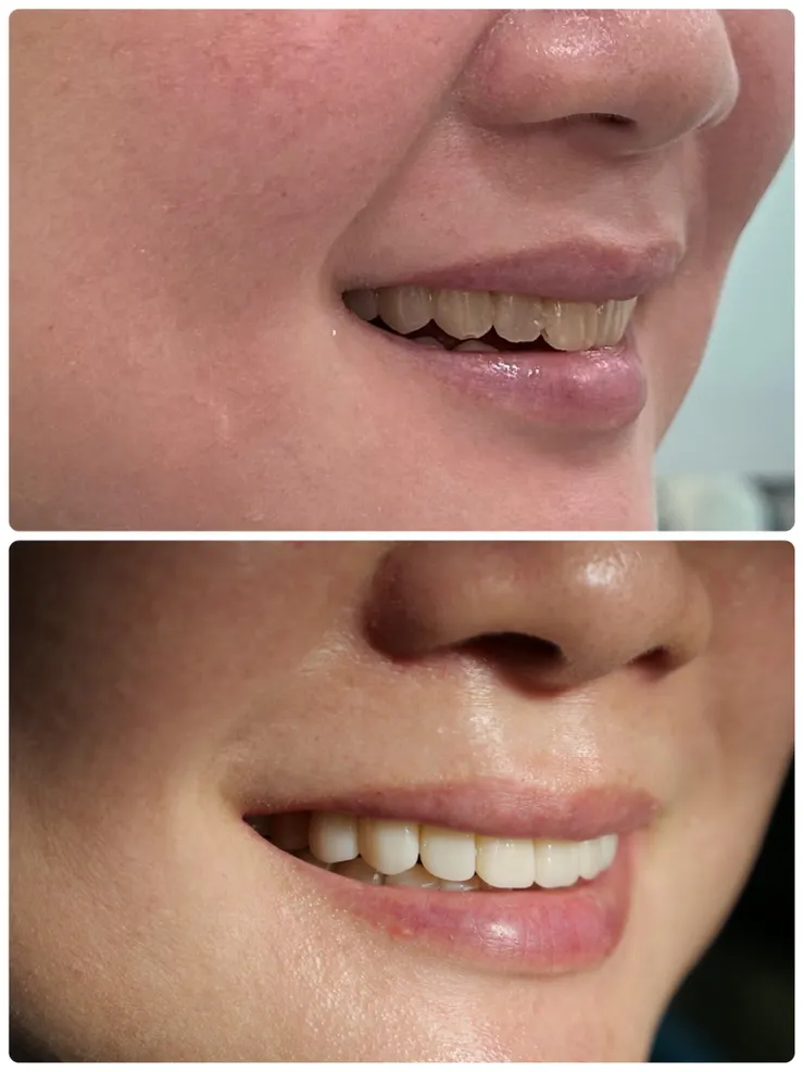 渥爾牙醫診所：大安區頂級美白牙齒貼片！不必等待的笑容蛻變，立即打造自信光采！