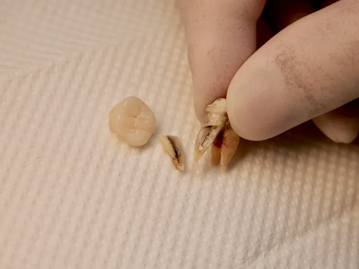 渥爾牙醫提醒！氧化鋯牙冠雖然很硬，但你還是不能亂咬！