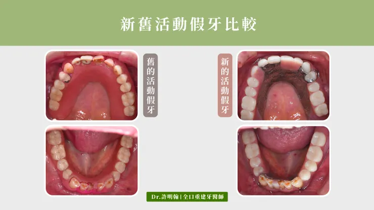 新舊活動假牙比較