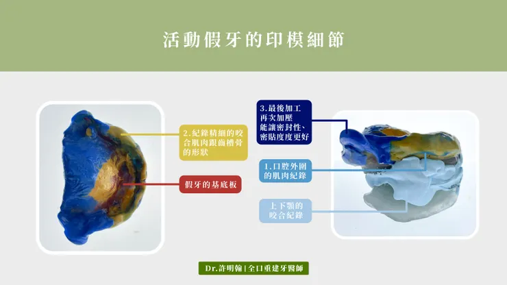 活動假牙的印模細節