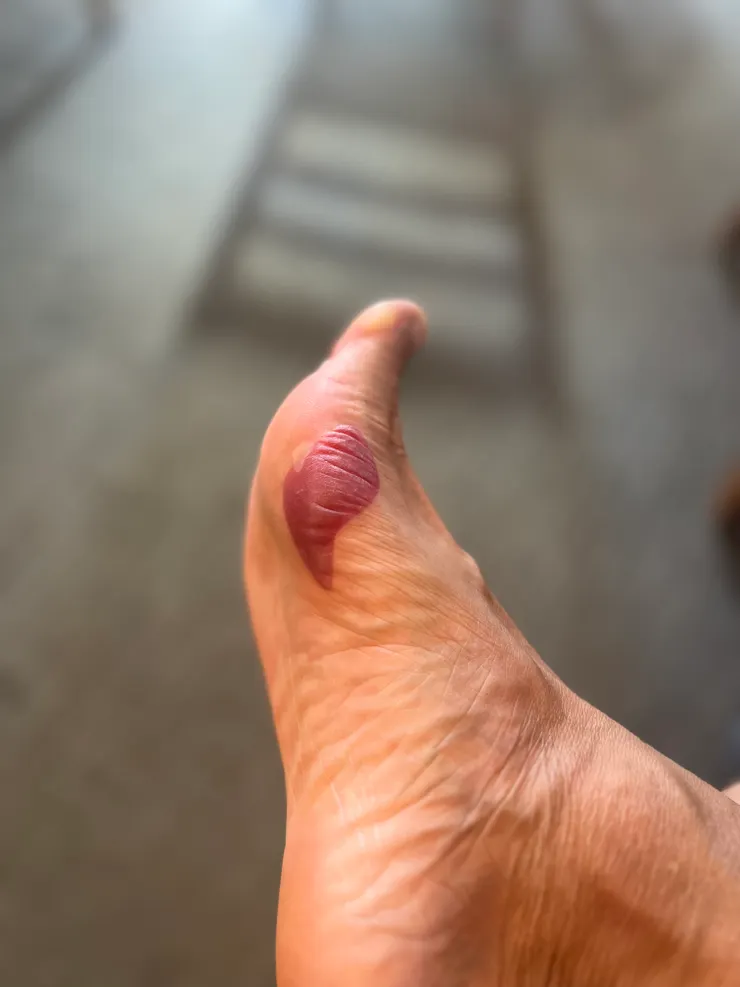 腳上摩出創下了紀錄的大水泡，老天一定要告訴我什麼事情