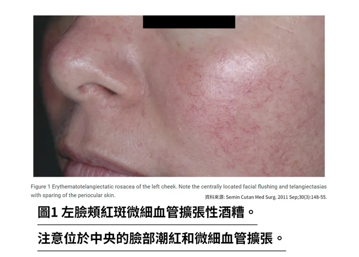 酒糟肌急救指南!