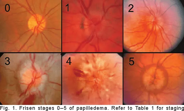 視神經乳頭水腫— Edgardo Ulysses Nguyen Dorotheo