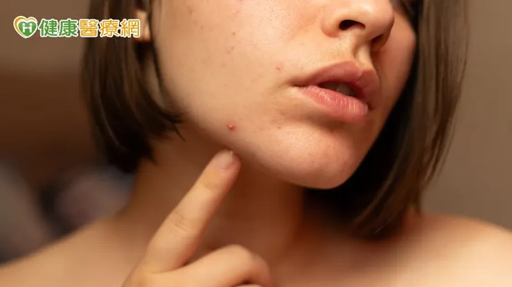 廖怡華理事長指出，壓力荷爾蒙與皮脂腺分泌油脂有關，因此現代人生活壓力大也成為爆痘原因之一。
