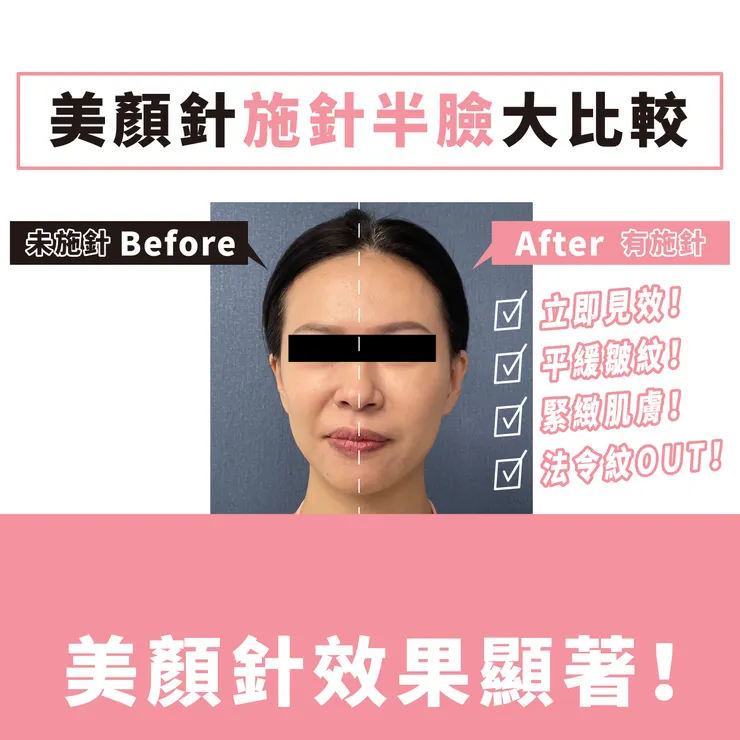 美顏針施針半臉大比較