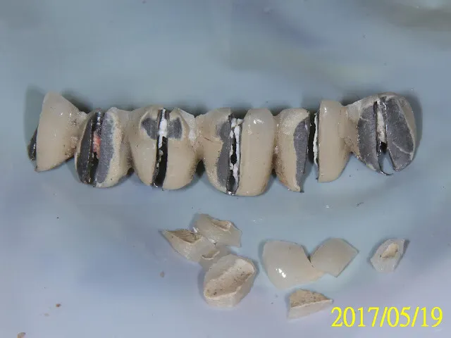 舊假牙拆下來是四分五裂的殘破，不太可能可以重新利用，多只能重新製作新的假牙，治療期間可能會有臨時牙套撐場面（圖在下方2018年有補照）