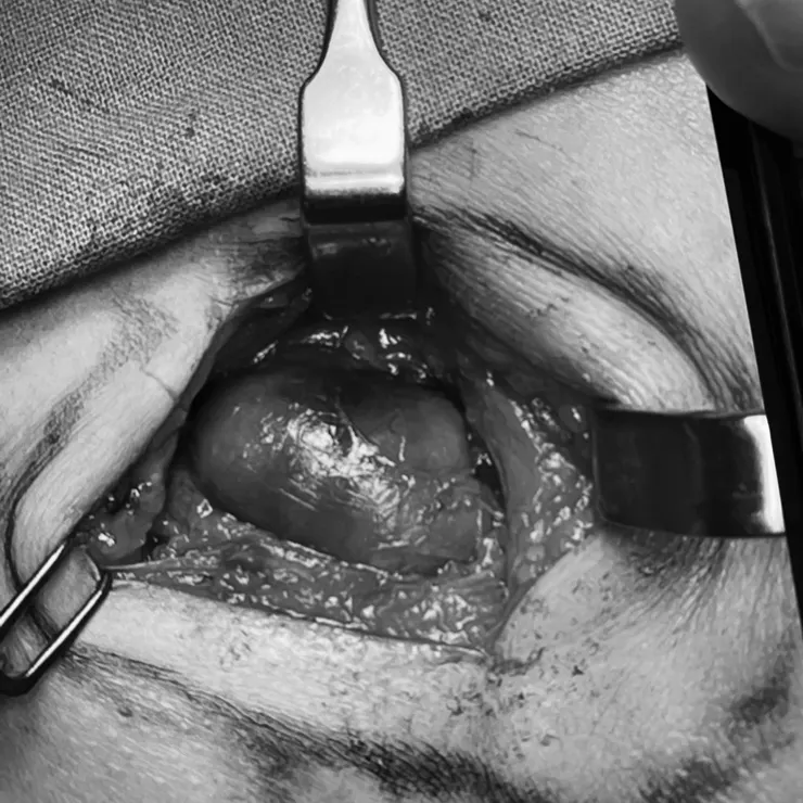 打開頸部看到的腫塊（用黑白圖比較不嚇人）