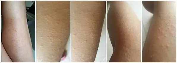 2017年皮膚嚴重過敏的情況，手腳發了密密麻麻的疹子