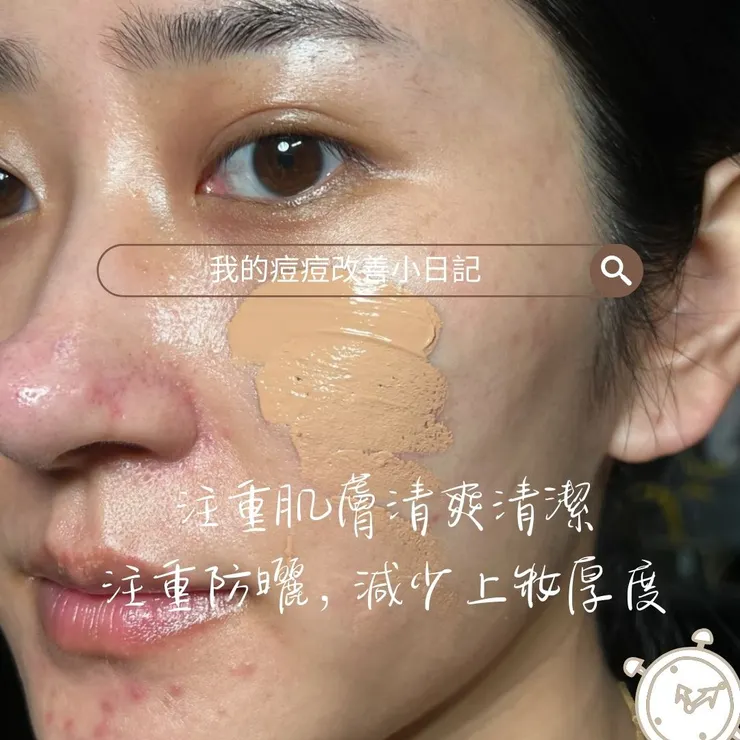 有效改善生理痘方法