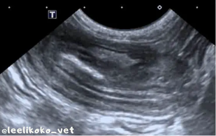 腹腔超音波- 腸套疊位置縱切面