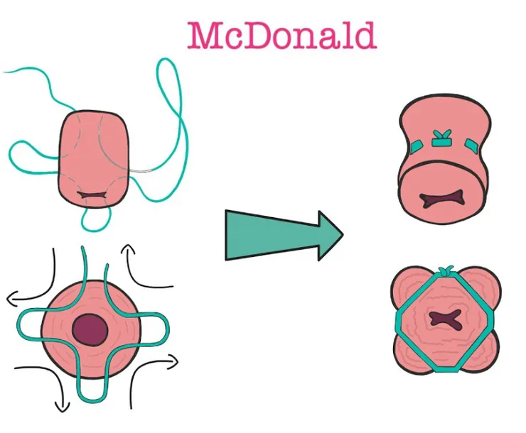 子宮頸環紮手術 - 麥當勞款