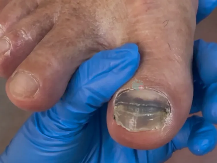 爬山指甲瘀青台北板橋維妮問題指甲