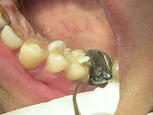 渥爾牙醫診所:斜裂小臼齒修復案例!Cap-Lock全瓷系列的完美應用(案例一)