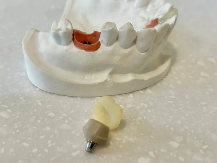 渥爾牙醫診所：植牙不只要穩，更要懂得「避震」！認識Bio-HPP新材料植體假牙