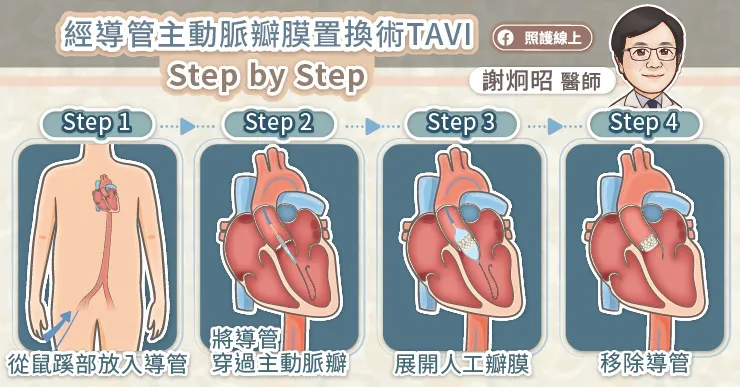 經導管主動脈瓣膜置換術TAVI