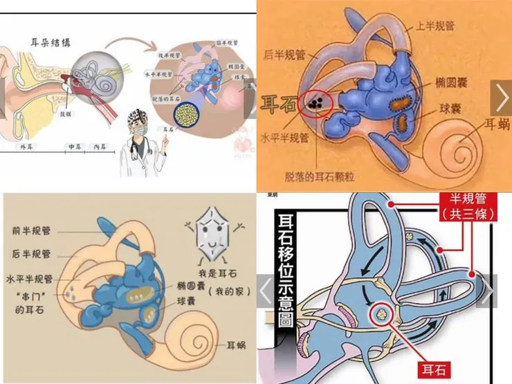 網路搜尋關於「耳石脫落」的資料