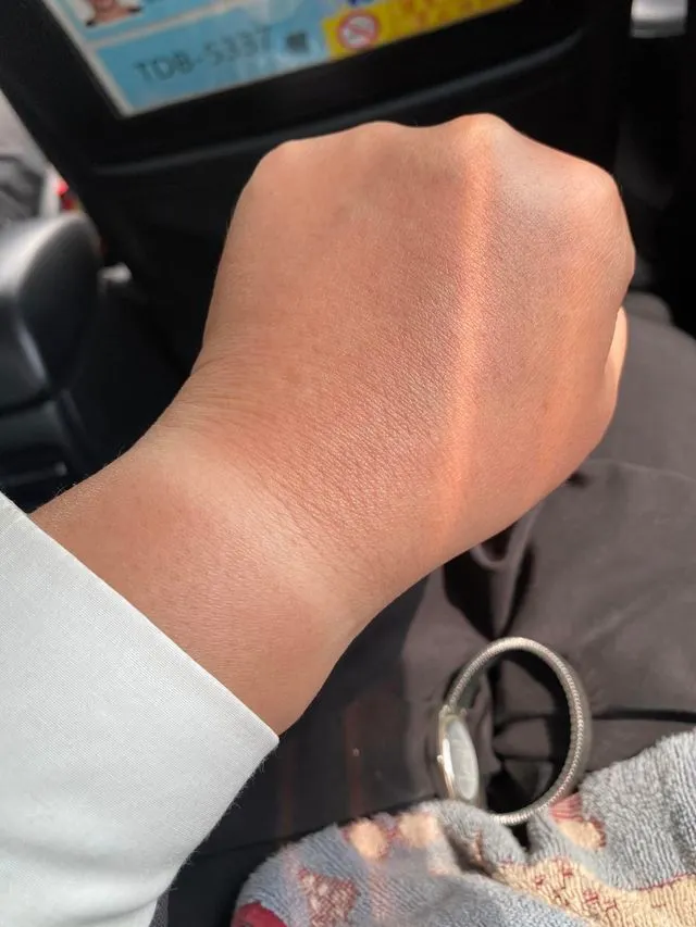 實在太輕忽了，連曬傷都被太陽復刻