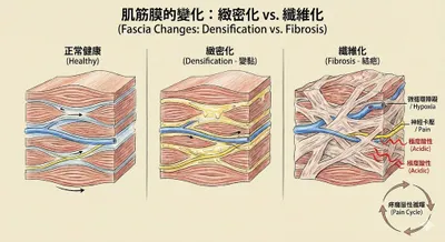 認識疼痛原因：肌筋膜的「緻密化」與「纖維化」