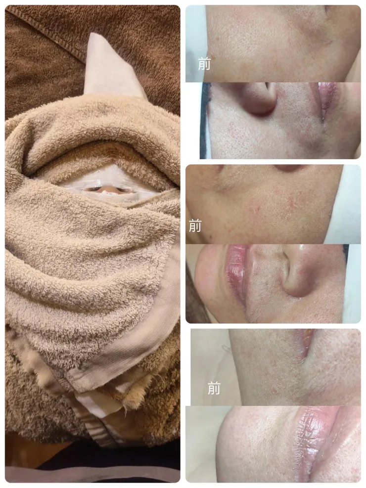 她清粉刺是出名且不會痛的哦。犧牲演出~