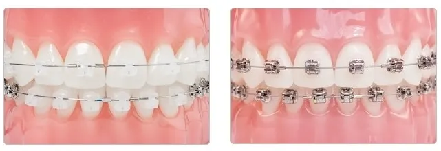 什麼是牙齒矯正？善貝口腔何麗珠醫生分享