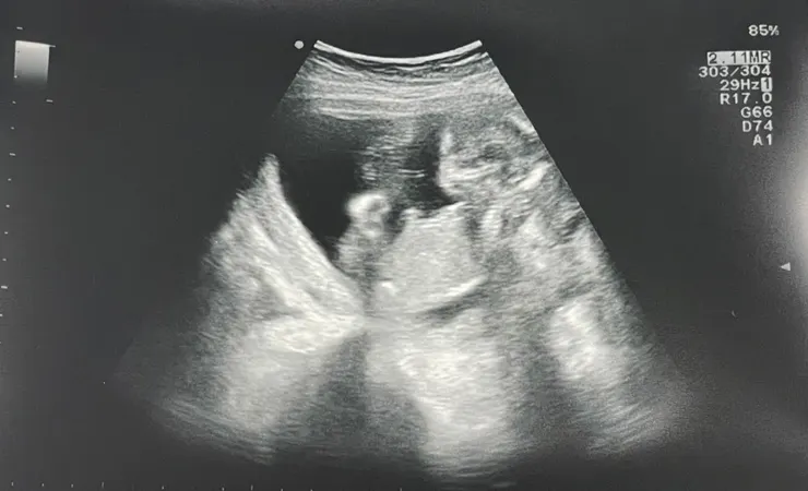 15週超音波胎兒圖/Ching