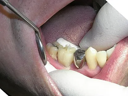 渥爾牙醫診所: Cap-Lock全瓷系列修復案例!斜裂下大臼齒的成功修復!