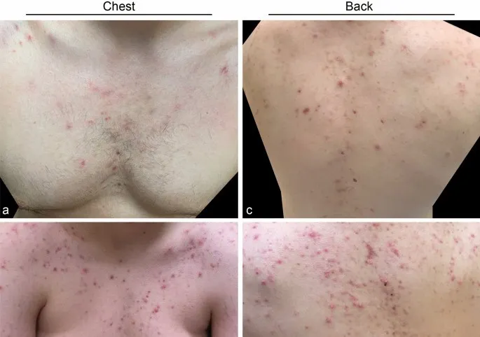 軀幹型痘痘  文獻來源:https://link.springer.com/article/10.1007/s40257-022-00746-4