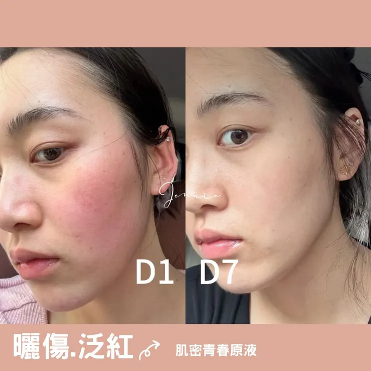 曬傷泛紅-肌密青春原液