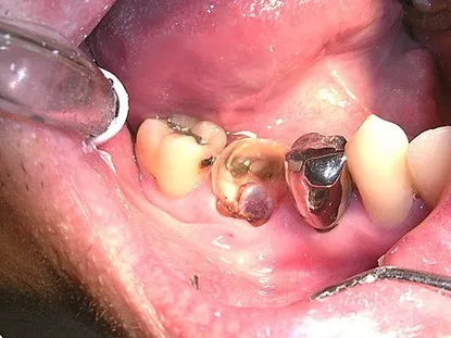 渥爾牙醫診所: Cap-Lock全瓷系列修復案例!斜裂下大臼齒的成功修復!