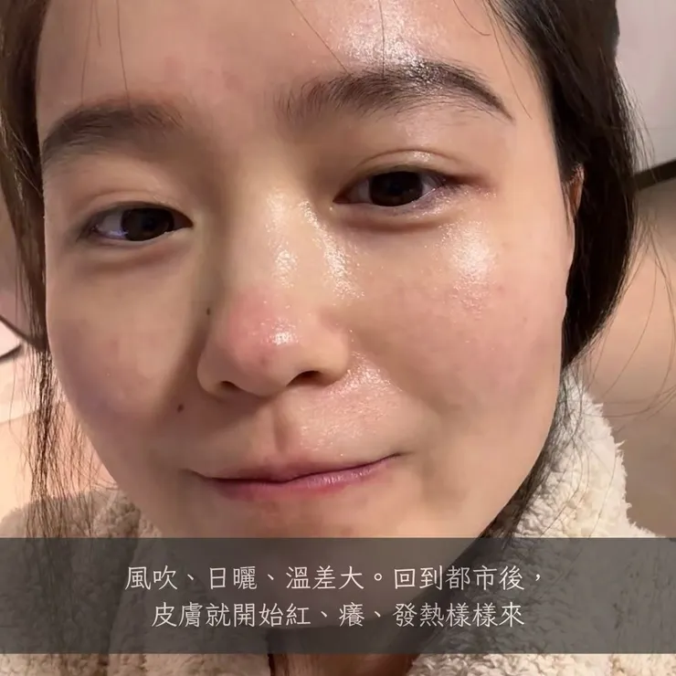 酒糟肌護理的日常注意事項