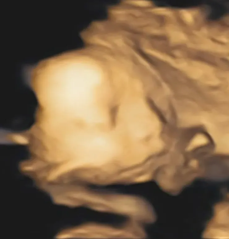 25W+6D的大頭寶寶