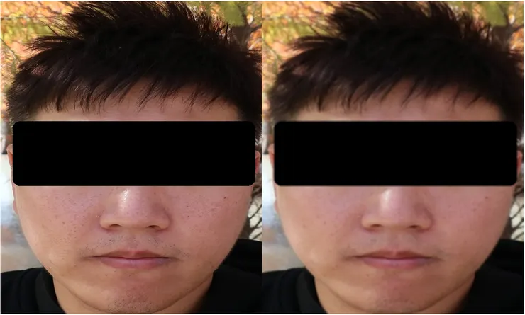 皮膚平滑效果